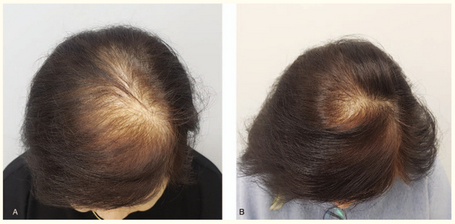 Hair growth with red light therapy CURED light therapy